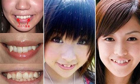 Japanese Women Paying Hundreds Of Pounds To Have Crooked Fang Like Teeth In Latest Cosmetic