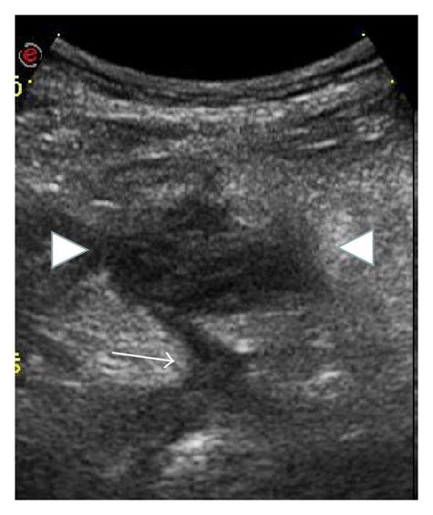 Bowel Ultrasound In A 22 Year Old Female With Ileocolonic Crohns