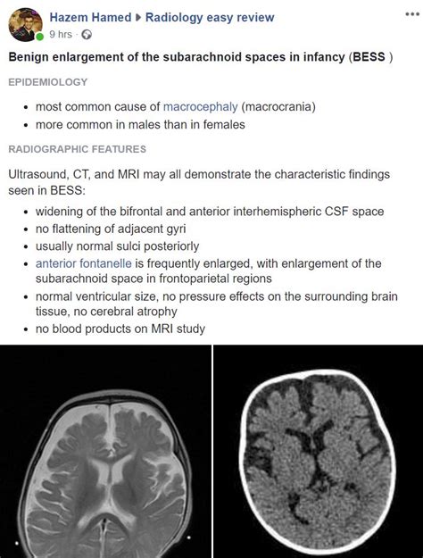 Benign Enlargement Of The Subarachnoid Spaces In Infancy Bess The