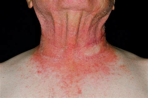 Photosensitive Rash On The Neck Photograph By Dr P Marazziscience