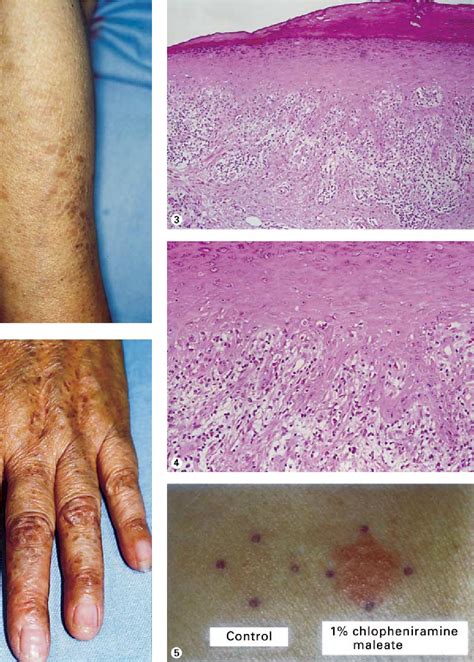 Figure 1 From The Diagnosis Of Lichen Planus Like Contact Dermatitis To
