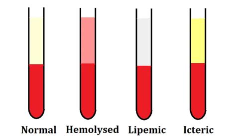 Tests Affected By Hemolyzed Lipemic And Icteric Samples And Their