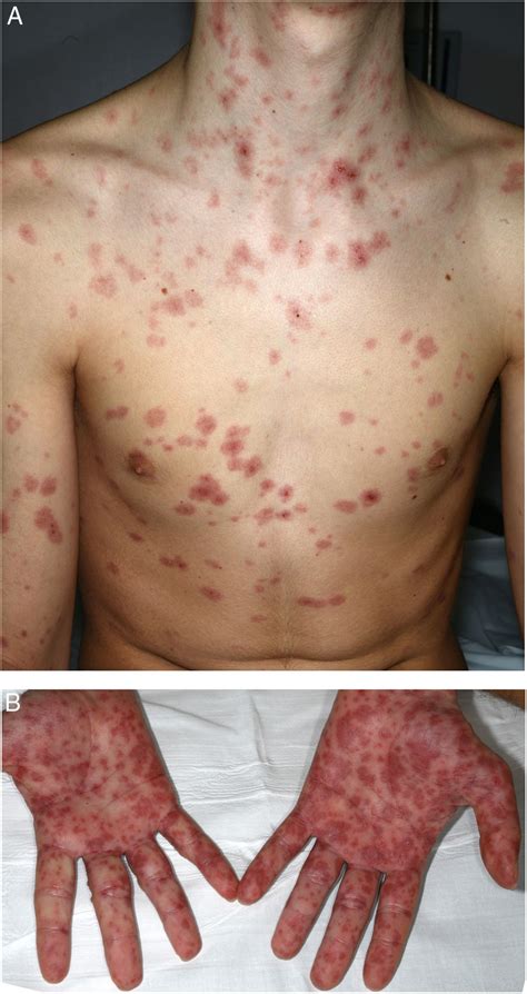 Stevens Johnson Syndrome Secondary To Doxycycline Treatment In A