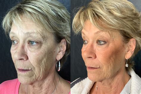 facial filler before and after bella vi