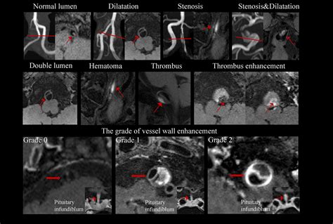 Assessment Of Morphological Features And Imaging Characteristics Of Patients With Intracranial