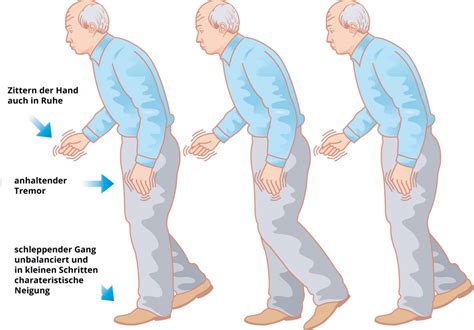 Parkinson Symptome Typische Anzeichen Erkennen Was Tun