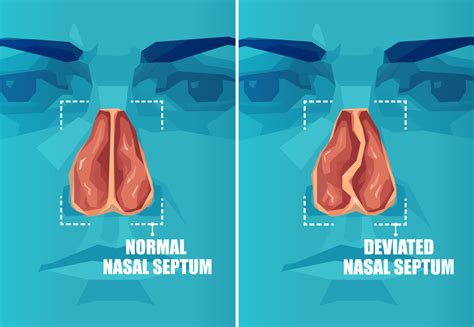 Nasal Septum Deviation Symptoms Causes Treatment