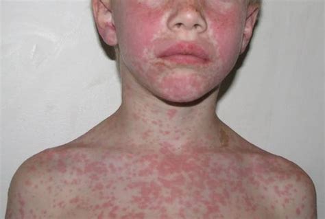 Amoxicillin Allergie Hautausschlag Nach Amoxicillin Wie Natürlich