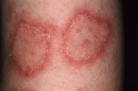 Atacicept Effective For Systemic Lupus Erythematosus Activity Severity
