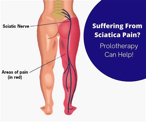 Get Rid Of Sciatica Pain Without Surgery The Prolotherapy Clinic