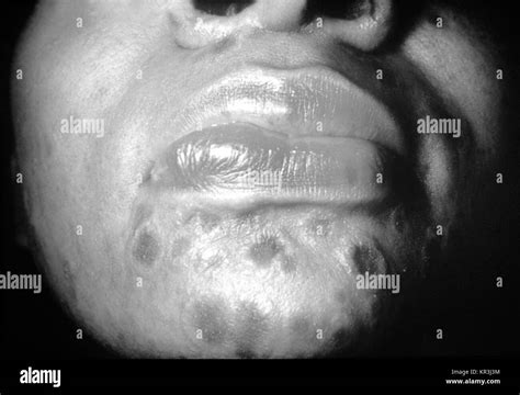 Skin Lesions Face Hi Res Stock Photography And Images Alamy