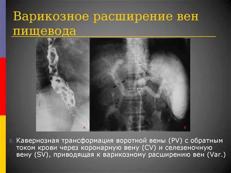 Диета при системной склеродермии