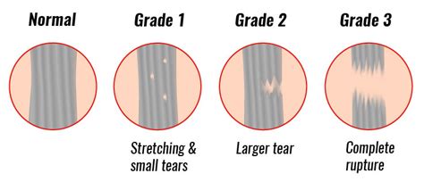 Sprained Ankle Treatment Rehabilitation And Exercises