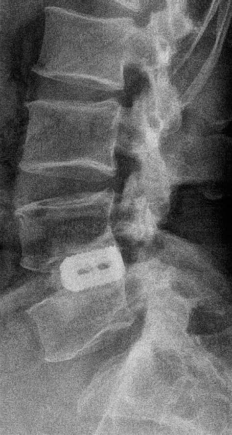 Simple Lateral Radiograph After Screw Removal Shows Appropriate And