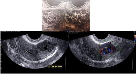 Transvaginal Ultrasound From A Granulosa Cell Tumor The Lesion Appears