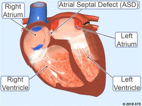 Atrial Septal Defect Newport Cardiac And Thoracic Surgery