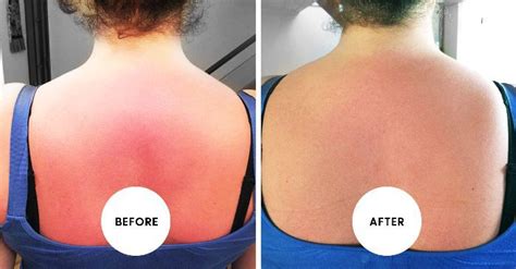 This is how to treat sunburn and stop that redness in its tracks. This Sunburn Remedy Will Get Rid of Your Burn in Hours