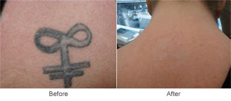 Therefore, they cannot be true experts in tattoo removal. Laser Tattoo Removal Treatment in St. Louis | Midwest Vein ...