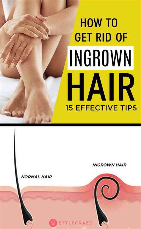 how to get rid of ingrown hair face bikini area legs arms ingrown hair unwanted hair