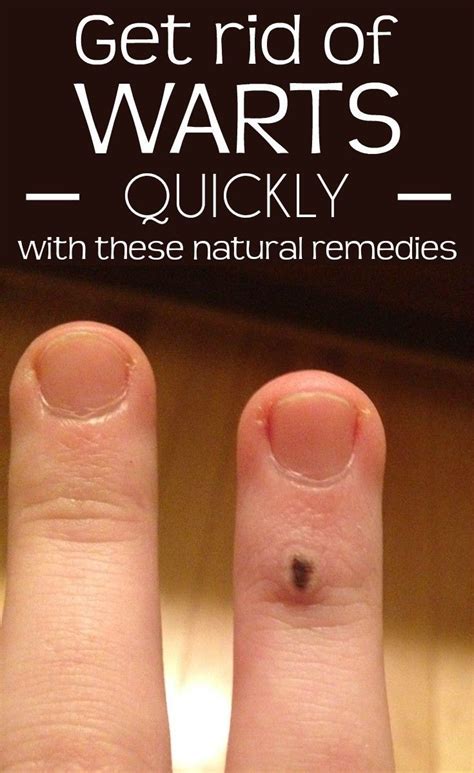 Get Rid Of Warts Quickly With These Natural Remedies
