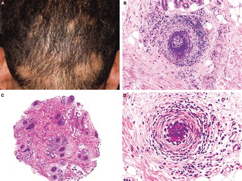 Histologic Features Of Alopecia Areata Other Than Peribulbar Images