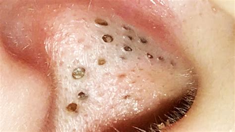 Pimple Popping Blackhead Extraction And Whitehead Pops What Makes Is