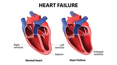 Best Cardiologist In Faridabad Heart Failure Symptoms