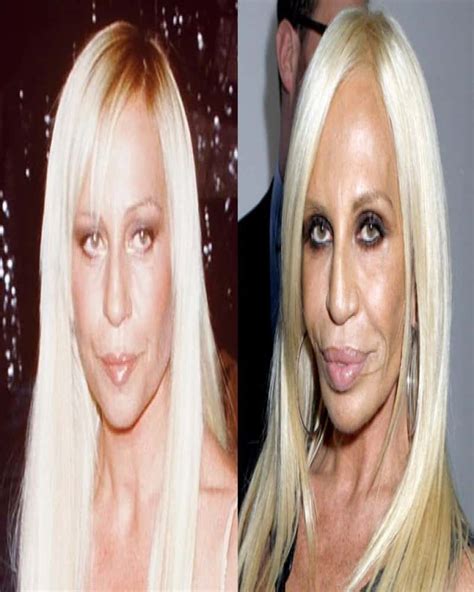 Worst Cases Of Celebrity Plastic Surgery Gone Wrong