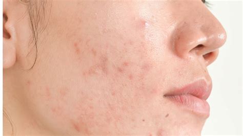 Teresa Paquin What Is Acne And Why Do I Have It Article 1 Acne Is A