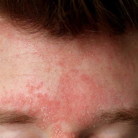 Facial Seborrheic Dermatitis Symptoms Causes And Treatment