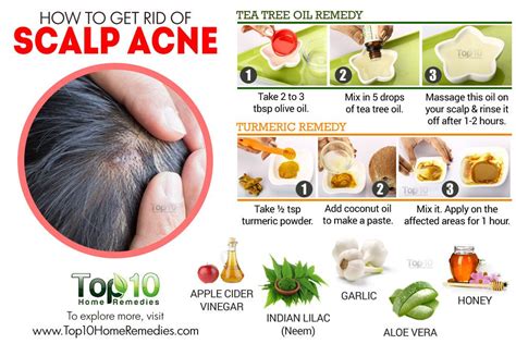 Scalp Acne Medical Treatment Home Remedies And Self Care Scalp Acne