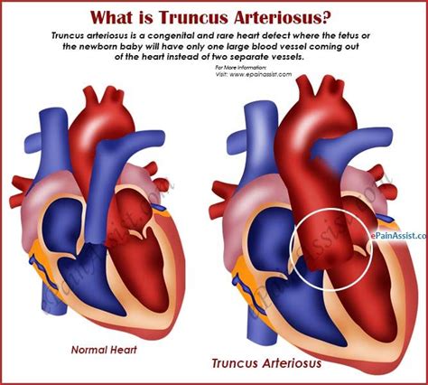 What Is Truncus Arteriosus Chd Awareness Pediatric Nursing