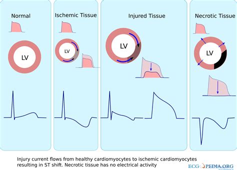 Filechanging Stsvg Ecgpedia