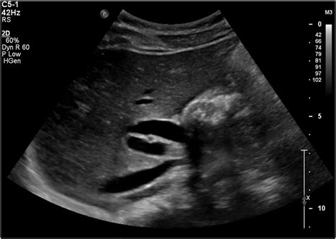 Ultrasound Of The Liver Demonstrating Dilated Common Bile Duct With