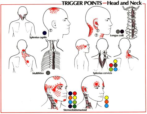 The Cloward Signcervical Referral Patterns — Rayner And Smale