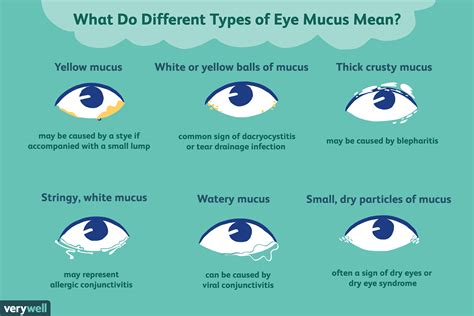 Identificar Los Tipos De Moco Ocular Medicina B Sica