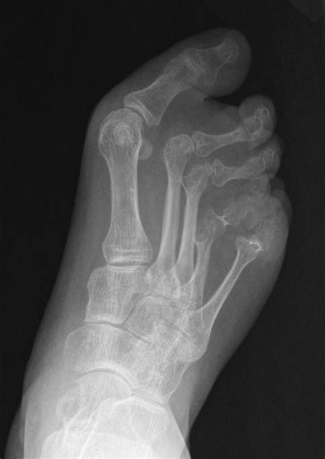 Topic Review Diagnostic Work Up Of Early Rheumatoid Arthritis In The Foot And Ankle Patient