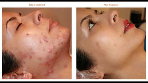 You can go to a dermatologist to get it either lasered or removed. Acne Remedies - Natural Acne & Pimples Cure ! - YouTube