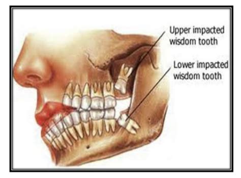 Dr John Landis D D S How Long Does It Take For Wisdom Teeth To