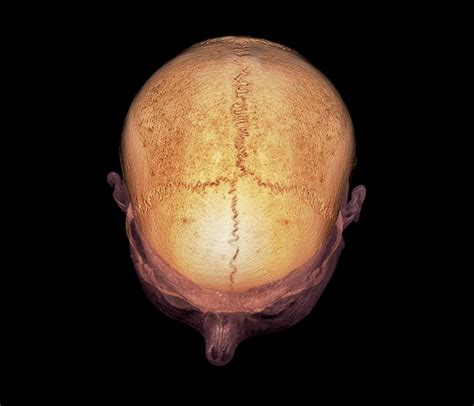 Skull Sutures Photograph By Zephyrscience Photo Library Pixels