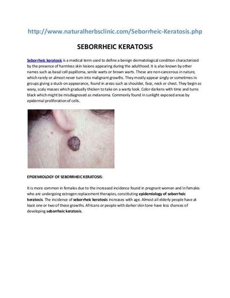 Seborrheic Keratosis Causes