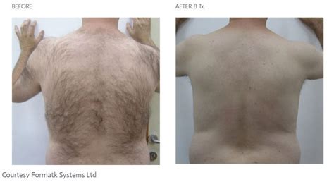 Laser Hair Removal Dr Scotts Restorative Health And Aesthetics