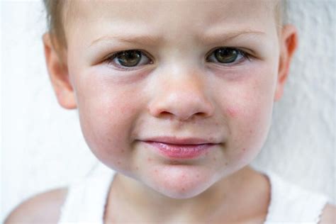 Wysypka wokół ust u dziecka przyczyny i leczenie Świat Rodziców