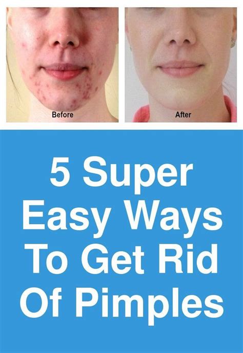 5 Super Easy Ways To Get Rid Of Pimples Normally Pimples Are Caused
