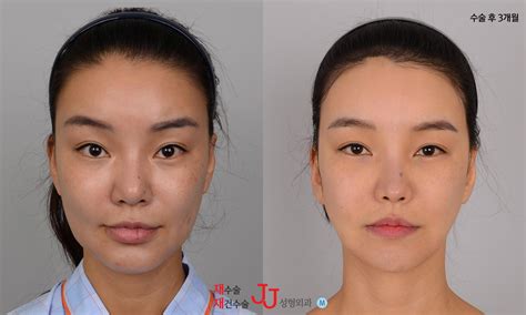 Korean Dimple Surgery