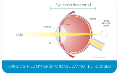 What Is Hyperopia Focus Clinics