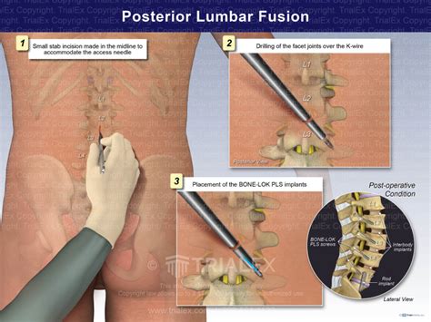Posterior Lumbar Fusion Trial Exhibits Inc