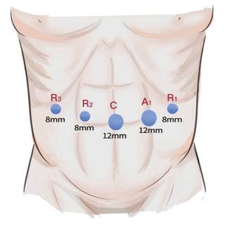 Port Placement For Robotic Pancreaticoduodenectomy R Robotic Arm Download Scientific