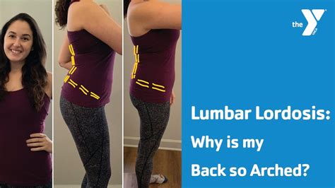 Lumbar Lordosis Why Is My Back So Arched Youtube