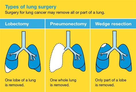 Lung Cancer Types Chart